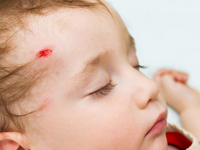 dấu hiệu chấn thương sọ não ở trẻ em